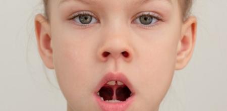 Bambina con denti mancanti, bocca aperta e sguardo fisso.